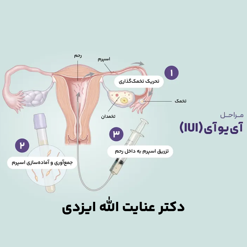 اهدای اسپرم با روش IUI