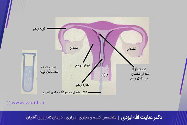 IUI چیست و ای یو ای موفق چه علائمی دارد؟